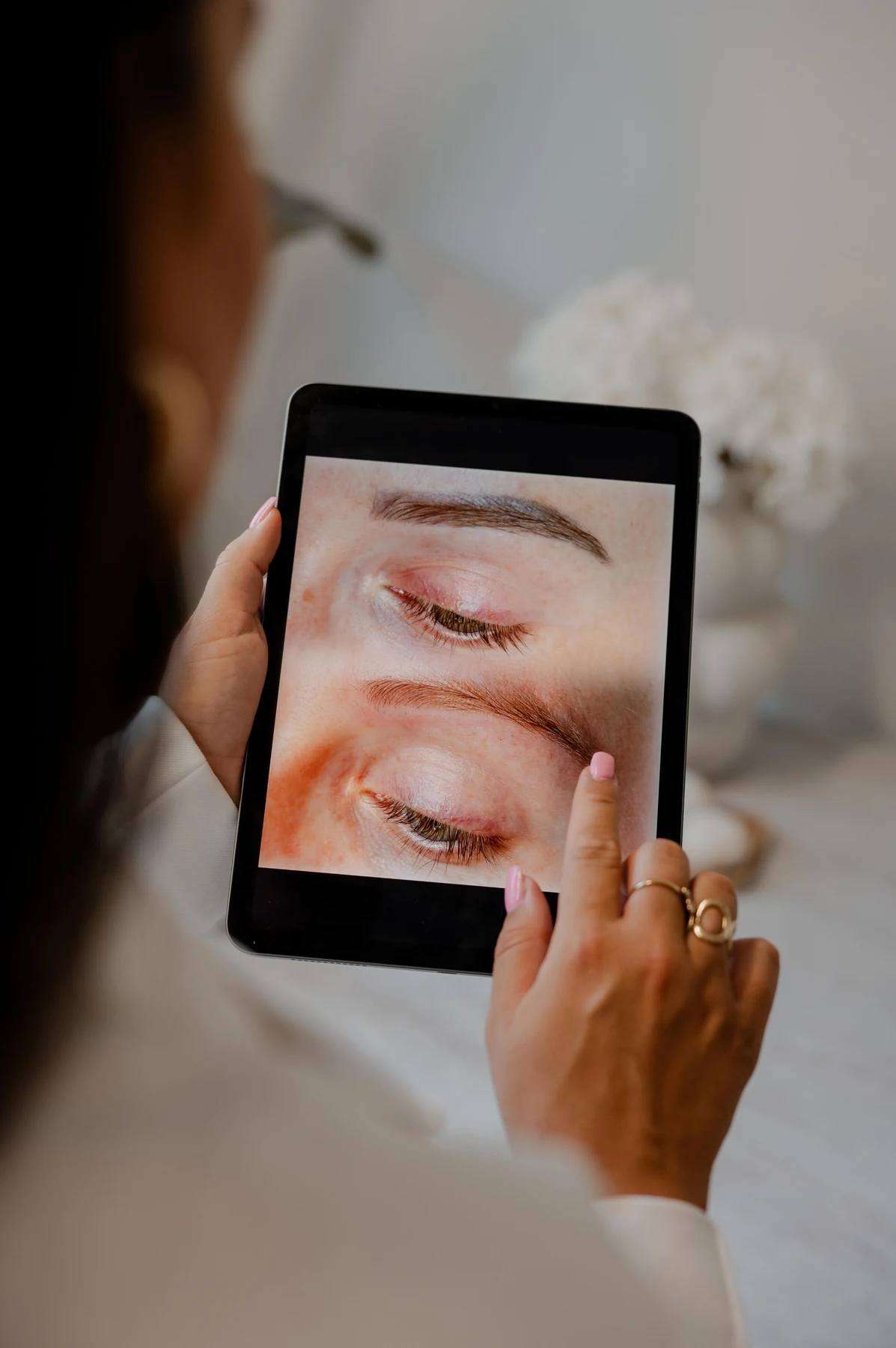 Voor- en na-resultaat van laser removal PMU getoond op een tablet bij By Shay